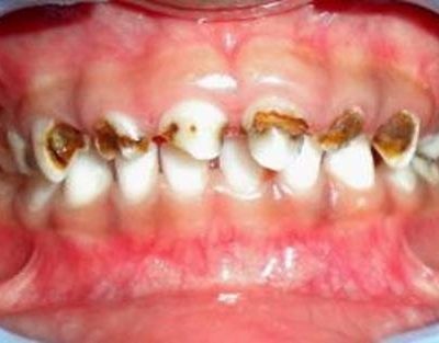 Kesihatan gigi kanak-kanak perlu diutamakan
