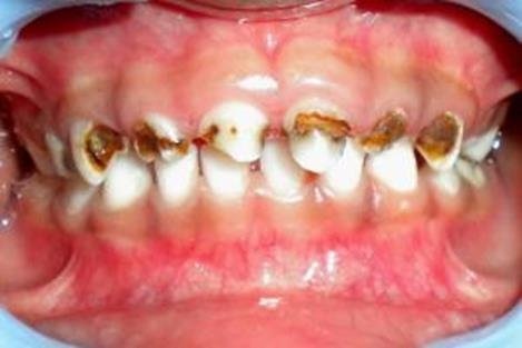 Kesihatan gigi kanak-kanak perlu diutamakan